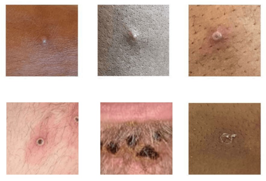 Skin lesions caused by the monkeypox virus. Photo: U.K. Health Security Agency