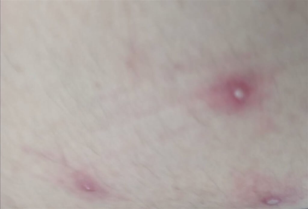 Blisters are seen on the patient