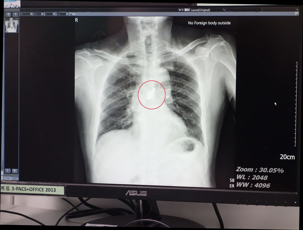 Doctors extract 6 cm steel grass-trimmer blade from Chiayi man’s chest