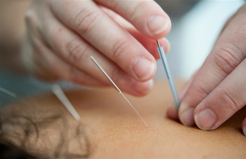 Western medicine doctors may perform acupuncture: Health ministry
