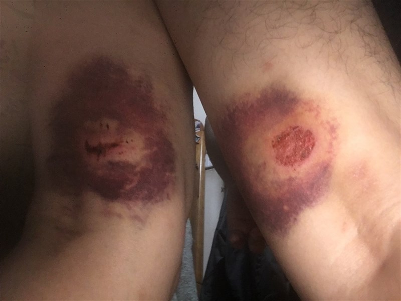 Bruises are seen on both of Ivan Choi’s legs after he was shot at close range by hong Kong police with a bean bag round on July 2, 2019. Photo courtesy of Ivan Choi Aug. 22, 2025