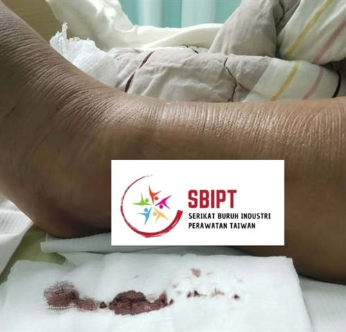 PMI terjatuh saat bopong pasien, kini dirawat di shelter