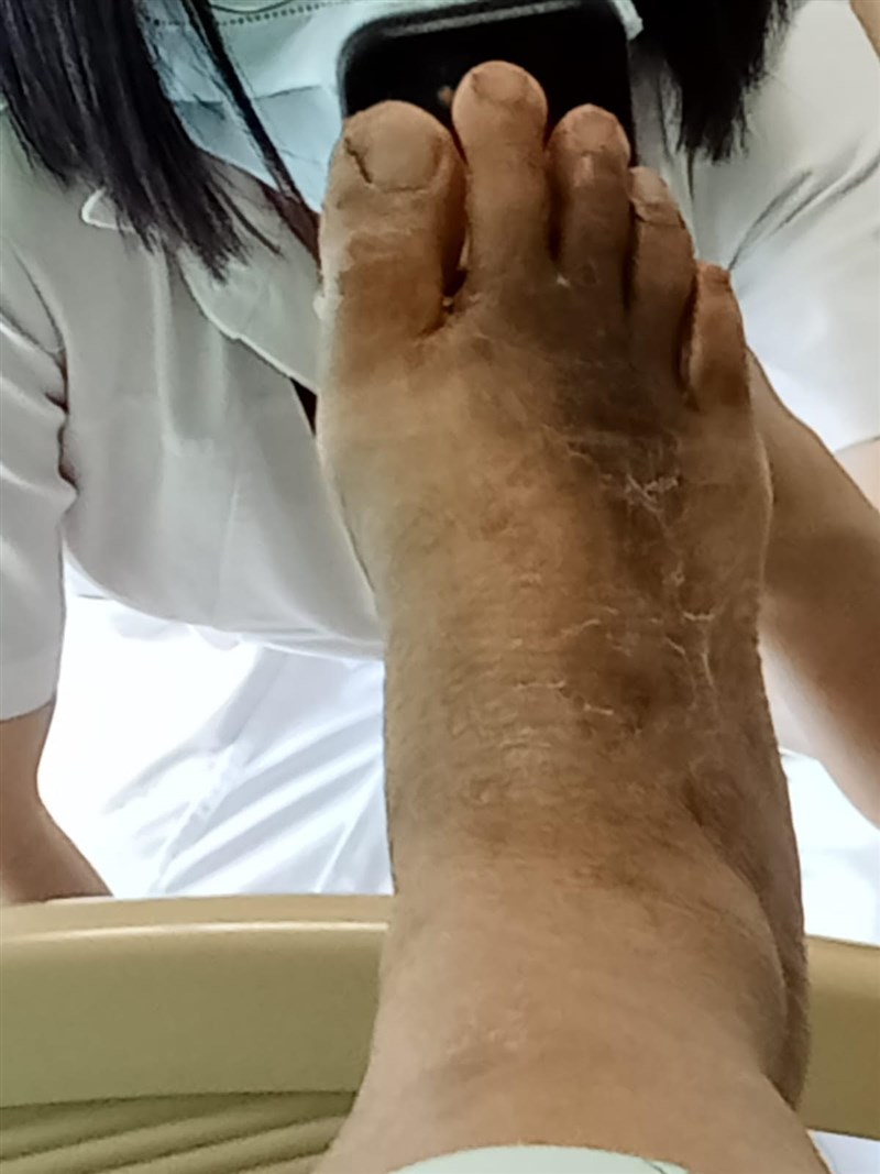Kaki Luluk menghitam setelah digigit ular. (Sumber Foto : Luluk).