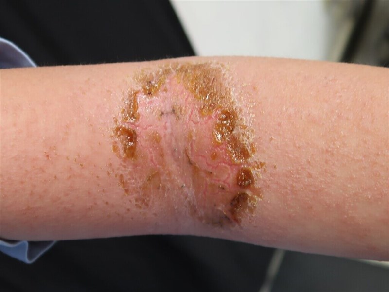 Dermatitis atopik. (Sumber: Rumah Sakit Asia University, 24 Desember 2024)