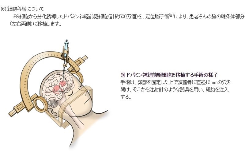 日本京都大學醫師以誘導性多功能幹細胞(iPS細胞)製成神經細胞,移植到帕金森氏症患者腦內。(圖取自京都大學iPS細胞研究所網頁cira.kyoto-u.ac.jp)