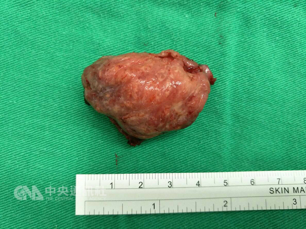 69歲葉姓男子左邊口腔原本有約1公分大腫瘤,兩個月後,惡化成5公分大的三期腫瘤,葉男趕緊就醫接受手術,將腫瘤切除。(彰化醫院提供)中央社記者吳哲豪傳真 108年1月23日