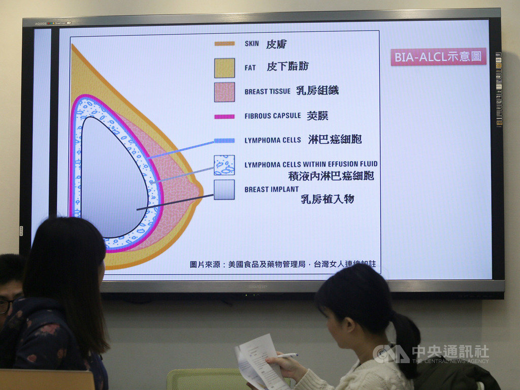 民進黨立委林淑芬與台灣女人連線23日在立法院舉行記者會,呼籲衛福部等相關主管機關,應讓台灣民眾了解開刀植入乳房植入物與間變性大細胞淋巴癌的關聯。中央社記者徐肇昌攝 108年2月23日