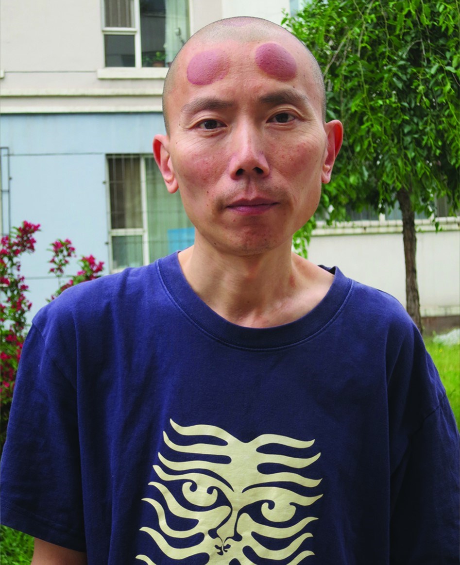 張銘額頭上兩個大大圓圓的紫紅色瘀青是「拔罐」留下的,這是唯一能減輕7年牢獄留給他劇烈頭痛的方法。(林慕蓮提供)