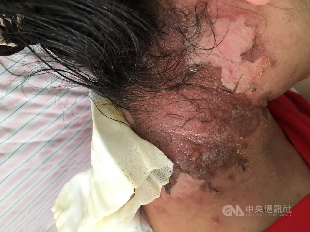 衛福部彰化醫院毒物科主任廖曜磐23日指出,名為「黑面馬」的植物常被視為治療跌抗損傷及筋骨酸痛的偏方,56歲賴姓婦人把黑面馬敷在皮膚上後,卻出現皮膚灼熱、變黑以及起水泡等接觸性皮膚炎的症狀,醫師呼籲民眾不要亂用或誤信草藥偏方,以免對健康造成傷害。(彰化醫院提供)中央社記者吳哲豪傳真 108年5月23日