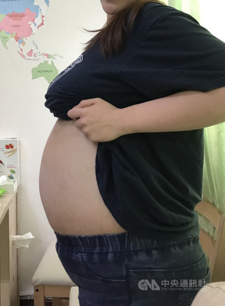 28歲的小如從小圓潤,步入職場後開始努力減重,但臉尖了、四肢瘦了,只有肚子消不下去,就醫檢查發現輸卵管長了40公分的大水瘤。圖為手術前。(國泰醫院提供)中央社記者陳偉婷傳真 108年6月11日
