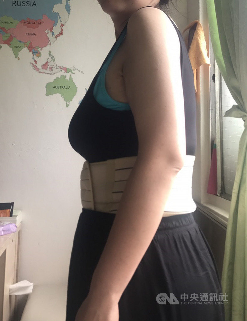 28歲的小如從小圓潤,步入職場後開始努力減重,但臉尖了、四肢瘦了,只有肚子消不下去,就醫檢查發現輸卵管長了40公分的大水瘤,經腹腔鏡手術切除,術後體重瞬間少掉16公斤。(國泰醫院提供)中央社記者陳偉婷傳真 108年6月11日