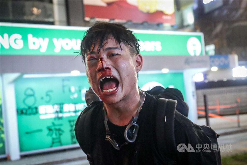 遭臥底港警襲擊的示威者,滿臉鮮血且門牙都被打斷。