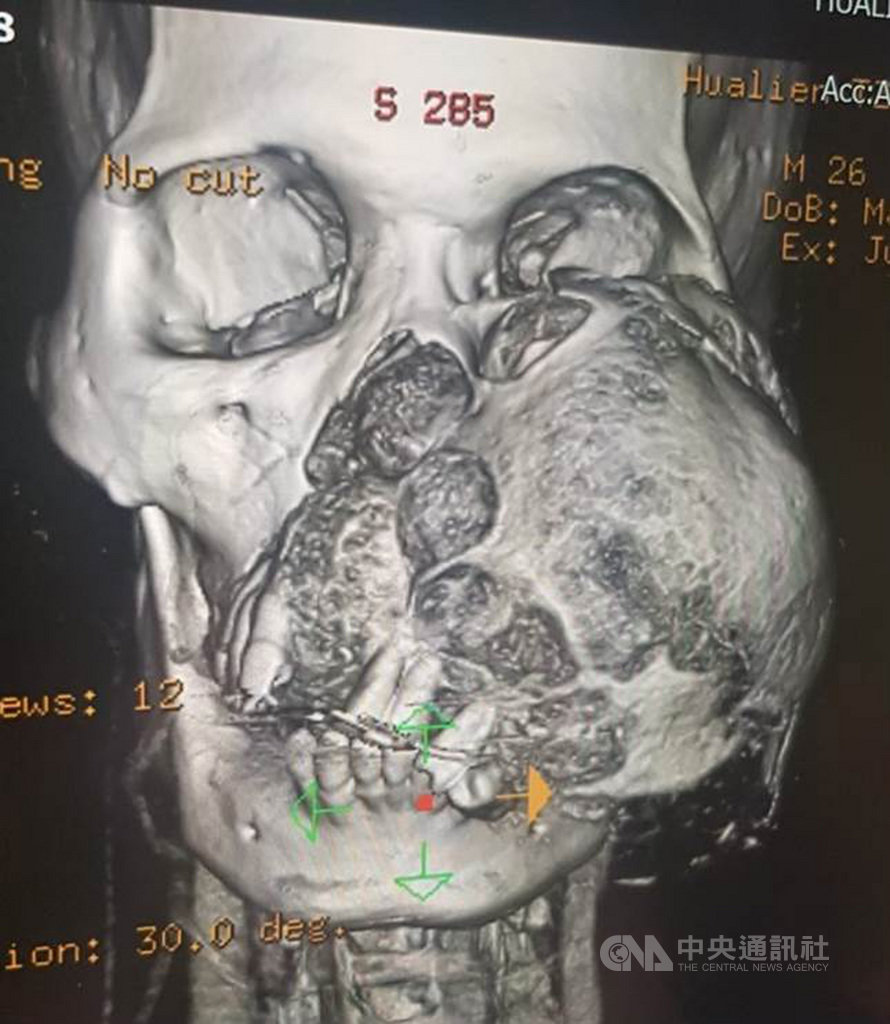 來自菲律賓的麥可左臉被巨大腫瘤吞噬,影響範圍包括顏面骨頭、左上顎鼻竇、鼻中隔,且位置深,造成多處骨頭遭擠壓破壞。(花蓮慈濟醫院提供)中央社記者張祈傳真 108年10月17日