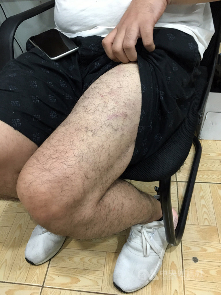 一名29歲的台灣人因租房糾紛,在大馬尼拉遭中國籍和馬來西亞籍嫌犯綁架虐打,18日晚上獲菲律賓警方救出。圖為被害人遭虐打傷痕。(菲律賓警方提供)中央社記者陳妍君傳真 108年10月22日