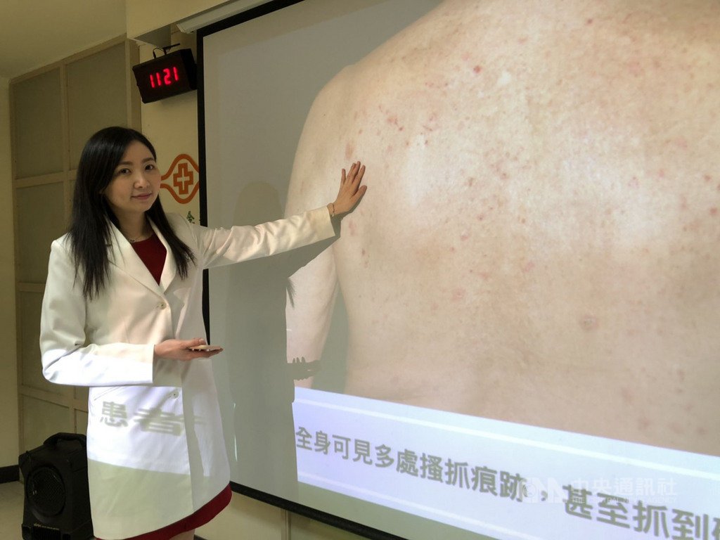 林口長庚醫院皮膚科醫師吳吉妮(圖)與美國史隆.凱特琳癌症中心攜手研究發現,若癌症患者接受免疫治療出現皮膚副作用,可能是藥物有效的表現,平均存活期比沒有此副作用者高出2.1倍。中央社記者張茗喧攝 108年11月12日