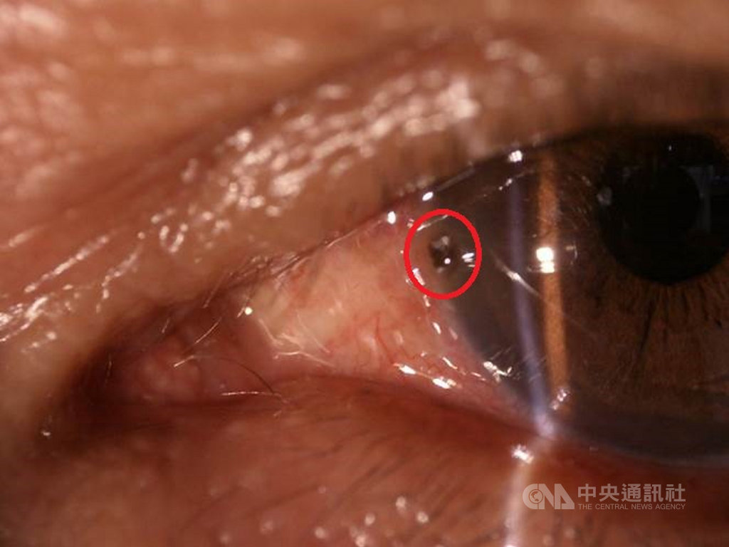 218公里遠距問診成功夾出老農眼球內鐵屑 生活 中央社cna