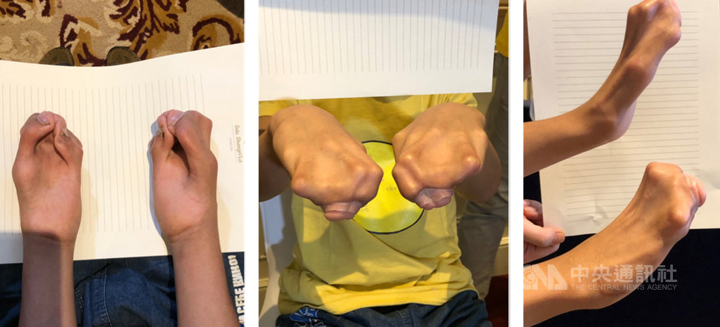 今年15歲的緬甸男孩張子墨罹患先天性手掌五指骨並連的疾病,無論是吃飯還是拿筆寫字都得雙手並用,用「夾」的方式完成,生活相當不便。(新光醫院提供)中央社記者陳偉婷傳真 108年12月23日