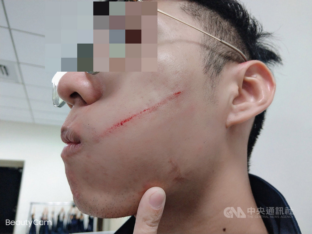 新北市一名婦人9日搭乘公車時未配戴口罩,司機勸導不聽只好報警,蘆洲警分局陳姓警員到場處理時,口罩竟遭扯下,臉頰也被婦人抓傷,警方10日將婦人依法送辦。(警方提供)中央社記者黃旭昇新北市傳真 109年4月10日