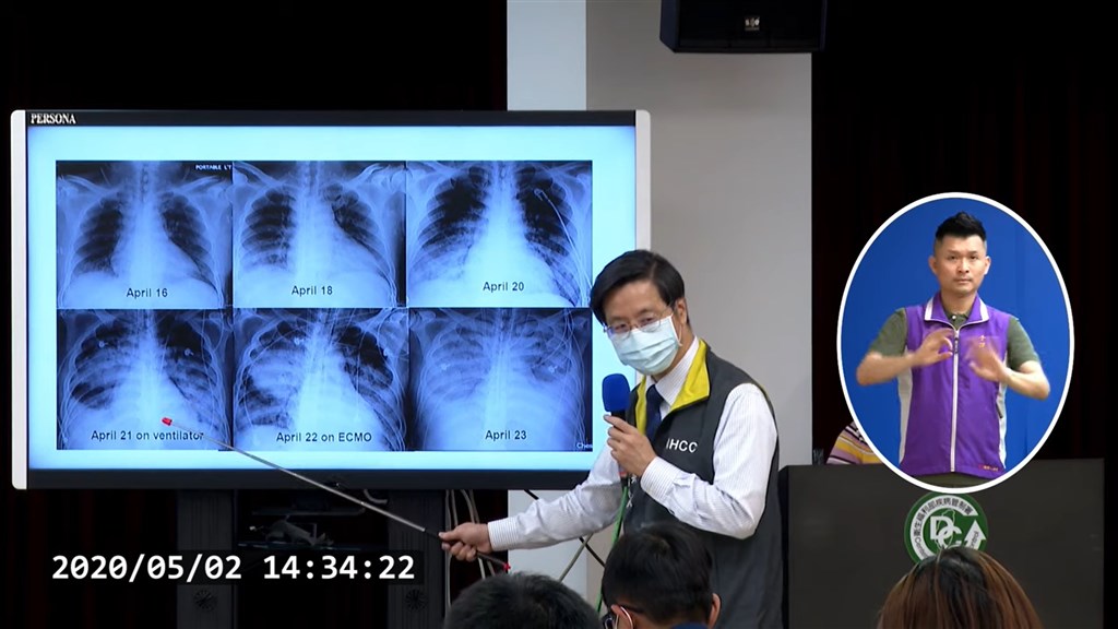 外界一直關心武漢肺炎康復者仍會有肺纖維化的後遺症,指揮中心專家張上淳2日分享H7N9病人經驗,證明感染後的肺纖維化可逐漸恢復。(圖取自疾管署YouTube網頁youtube.com)