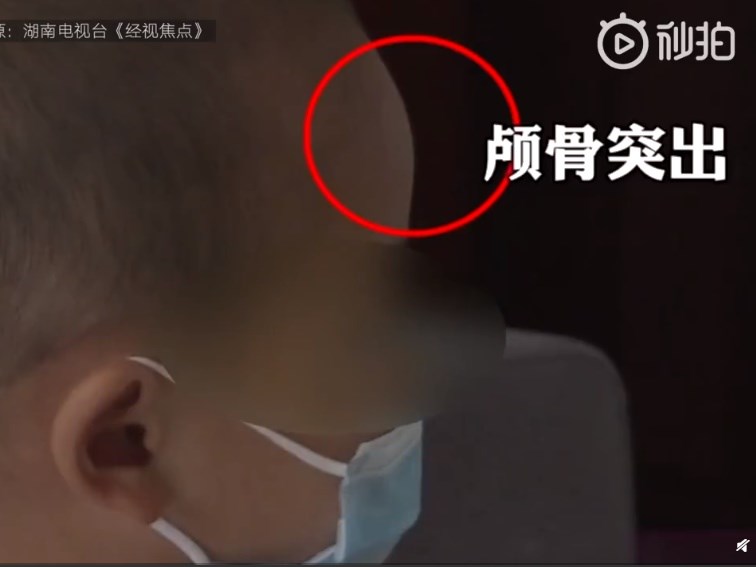 新京報報導,湖南郴州永興縣不少過敏兒的家長發現,自己的孩子最近不停拍頭又長濕疹且體重驟降,頭骨變成畸形的大頭娃娃。(圖取自新京報微博weibo.com)