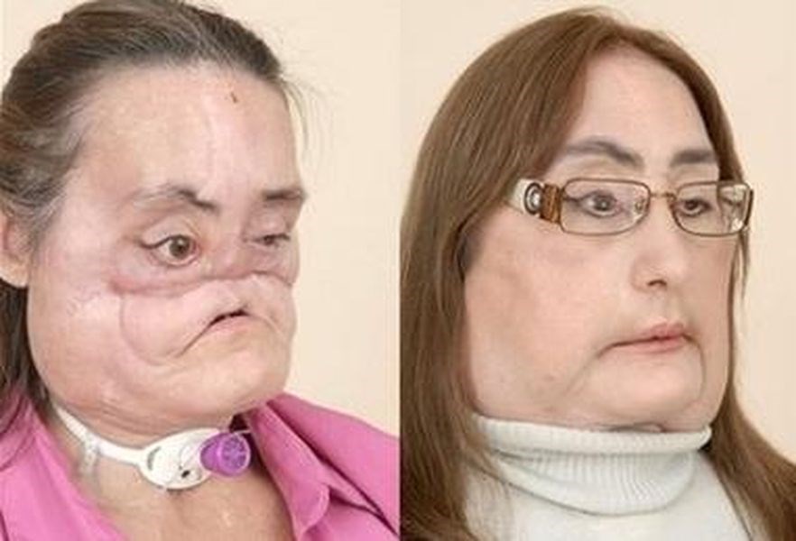 美國首名接受臉部局部移植的卡普已於7月底逝世,享年57歲。(圖取自維基共享資源網頁;作者Source,Fair use)