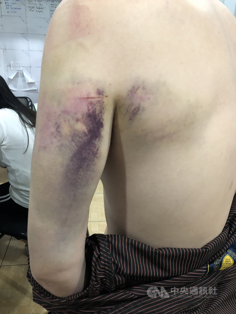 一名台灣籍男子在菲律賓向博弈公司求職後遭擄人勒贖,對方毆打凌虐這名男子,導致他左肩、左背、手臂大片瘀青。(駐菲代表處警政祕書王智勇提供)中央社記者陳妍君馬尼拉傳真 109年9月28日