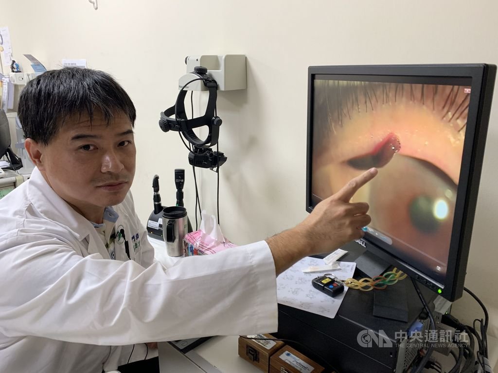 花蓮縣豐濱鄉69歲李姓男子日前上山砍草時疑似有異物跑進眼睛,2天後眼睛突然流血就醫,花蓮門諾醫院眼科主治醫師張立羣(圖)在李男眼中發現一條長約1公分水蛭,趕緊將水蛭夾出、消毒。(門諾醫院提供)中央社記者張祈傳真 109年9月29日