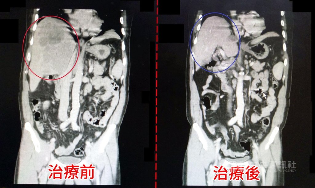 林姓男子患有C型肝炎加上喝酒習慣,肝臟長出一顆約14公分腫瘤,確診為晚期肝癌,經醫師評估以2次肝動脈化療,腹痛明顯改善,腫瘤也縮小至幾乎消失。圖為治療前後對比。(大千綜合醫院提供)中央社記者管瑞平傳真 109年9月29日