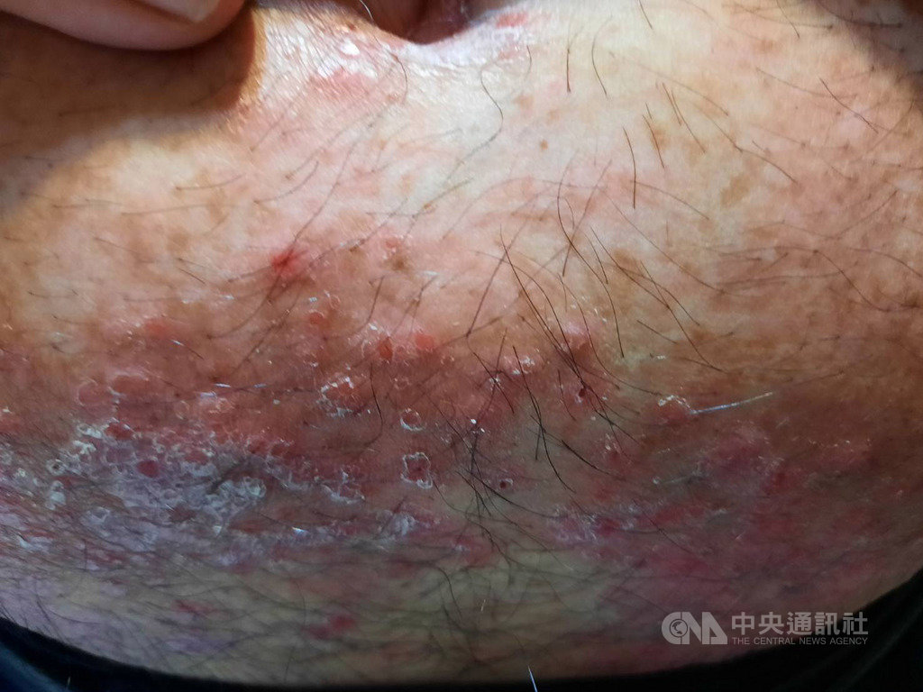台灣乾癬協會指出,乾癬是身體免疫疾病,因免疫系統異常,皮層會加速生長,身體各部位表面都可能出現病灶,不具傳染性,但仍嚴重影響病友的人際和求職。圖為乾癬病灶。(台灣乾癬協會提供)中央社記者陳偉婷傳真 109年10月18日