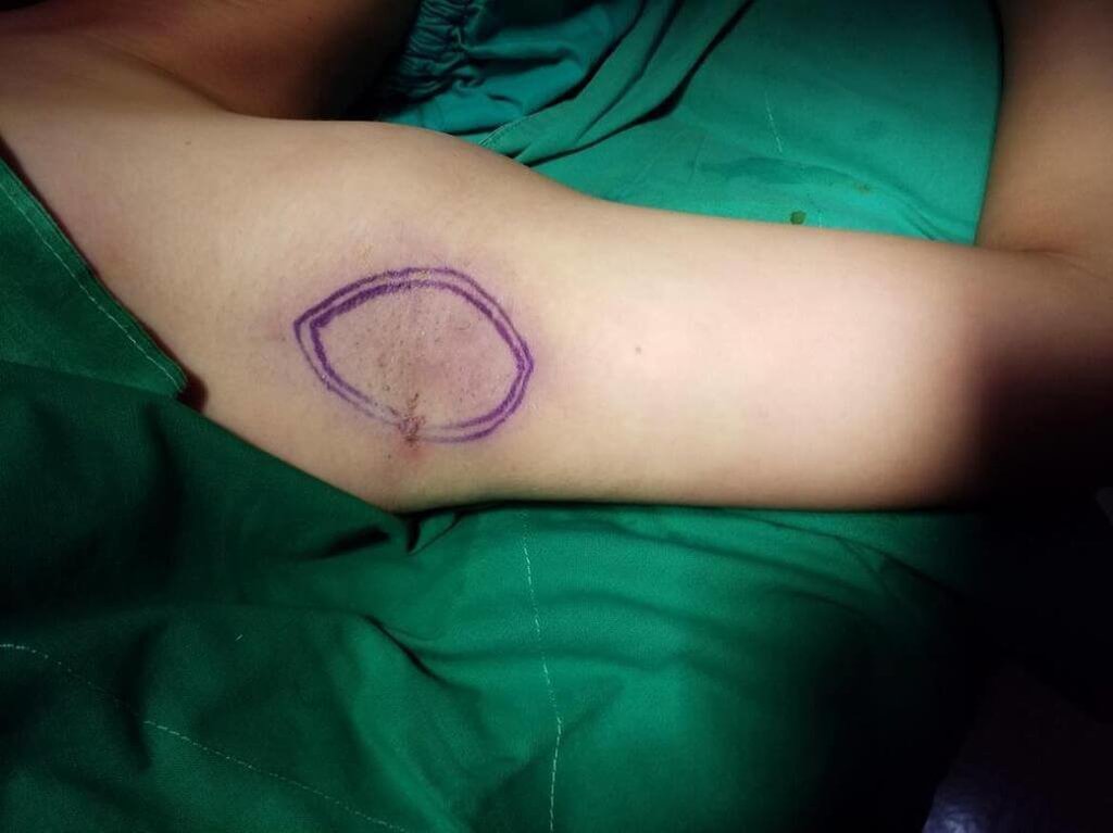 妙齡女身飄異味職場受挫　頂漿腺異常作祟