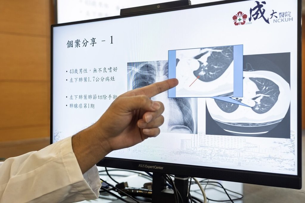 低劑量肺部電腦斷層　助早期診斷治療肺癌
