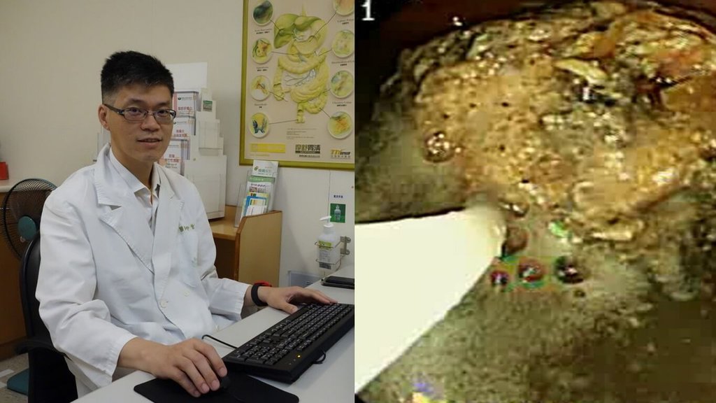 喝可樂消融胃糞石?醫師:變小後恐腸阻塞更麻煩