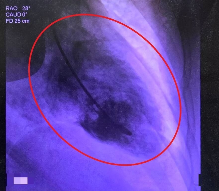 婦人遭車壓腳瘀青無大礙　竟驚嚇過度引發心碎症候群