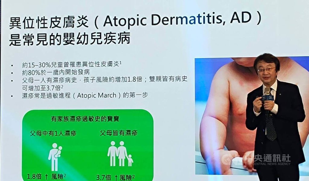 醫師:1歲前罹患濕疹 日後食物過敏、氣喘風險高 醫師:1歲前罹患濕疹 日後食物過敏、氣喘風險高