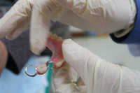 82歲婦不菸不酒罹舌癌 假牙內鉤反覆摩擦導致