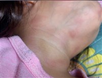 2歲女童頸瘀傷 台東嬤告幼兒園盼監視畫面釐清真相