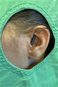 5旬婦跌倒筷子穿耳插入頭皮 醫師緊急拔除