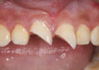 孩童撞斷恆齒 7天黃金治療期活髓保留成長潛能