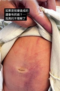 嘉縣滿月男嬰住護理之家腹瘀青疑受虐 家屬報警