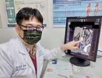 苗栗老婦長期腰背臀痠痛 醫揪肇因骨盆靜脈擴張