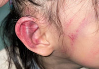 瑞芳某幼兒園疑虐童  家長控女兒耳瘀血腳遭棍打