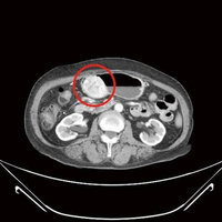 7旬婦腹痛血便 見6公分胃腸道基質瘤膽結石塞滿