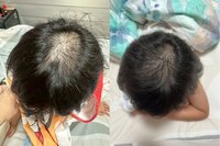 過度消毒惹禍 疫情寶寶過敏發病率增46%