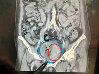 婦人連續無痛性血尿  醫揪出膀胱藏巨大腫瘤