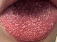 男童高燒不退併發草莓舌　醫：猩紅熱嚴重恐休克