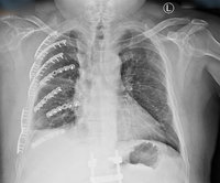 男排除掉落物遭撞斷肋骨　術後減痛恢復自由呼吸