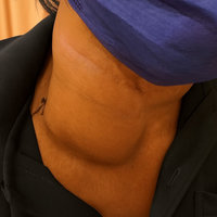 6旬男頸部淋巴瘤大如鴕鳥蛋　距氣管0.1公分險奪命