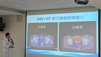 屁股痛竟是直腸癌　創新聯合療法縮小復發腫瘤