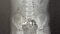 男童看電視吃餅乾誤吞吊飾　暫無影響待隨糞便排出