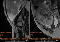 孕婦產檢見卵巢惡性腫瘤 馬偕醫院巧手守護雙生命